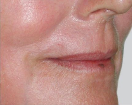 https://www.clinicahera.es/wp-content/uploads/2022/10/pillipe3_grey_after.jpg