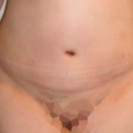 IMG_AFTER_Abdominoplastia_2