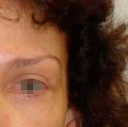 IMG_AFTER_Blefaroplastia_4