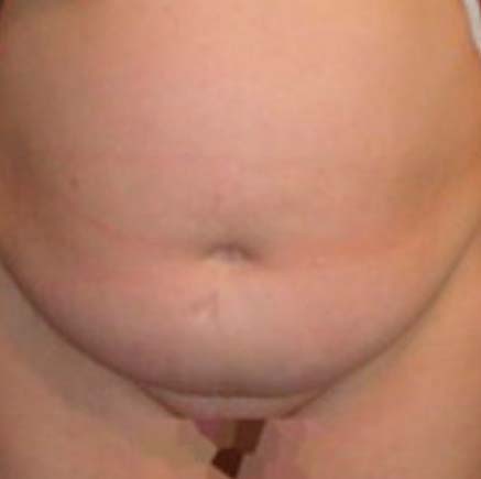 IMG_BEFORE_Abdominoplastia_2