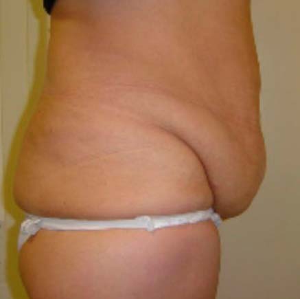 IMG_BEFORE_Abdominoplastia_3