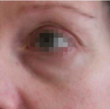 IMG_BEFORE_Blefaroplastia_1