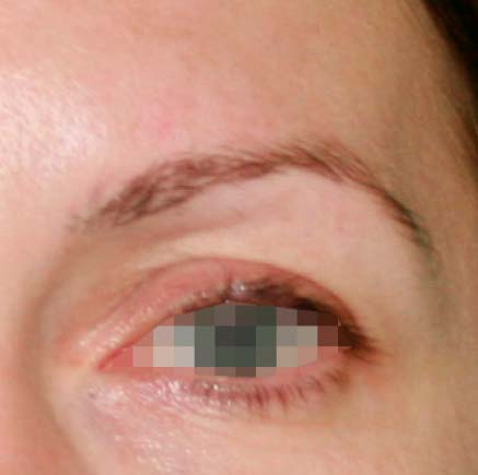 IMG_BEFORE_Blefaroplastia_2